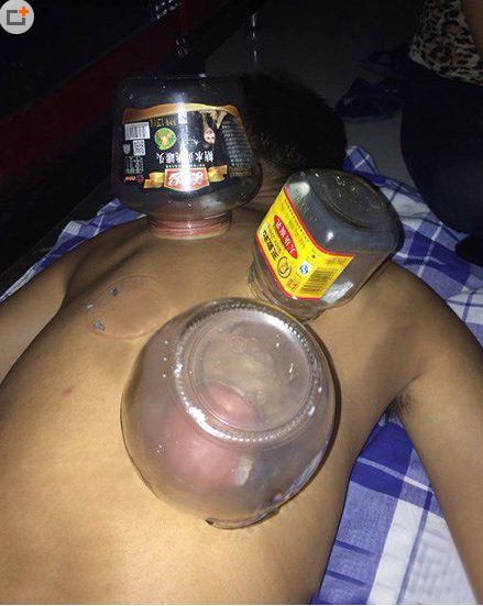 大學生奇葩搞笑的拔火罐